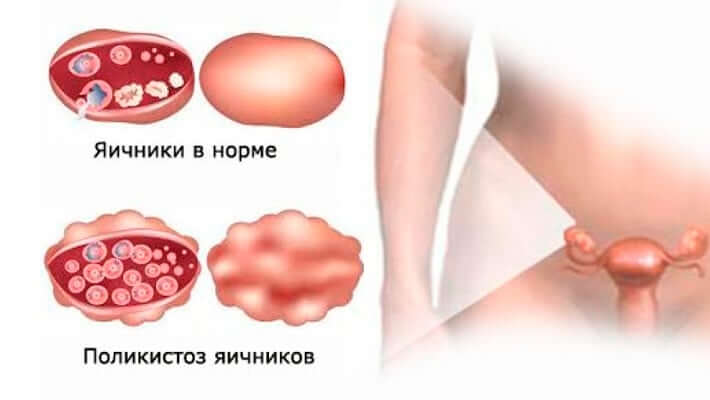 Как выглядит поликистоз яичников