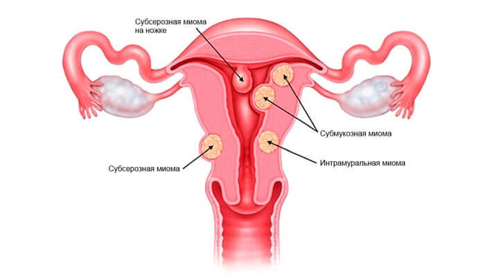 Диета После Миомы Матки