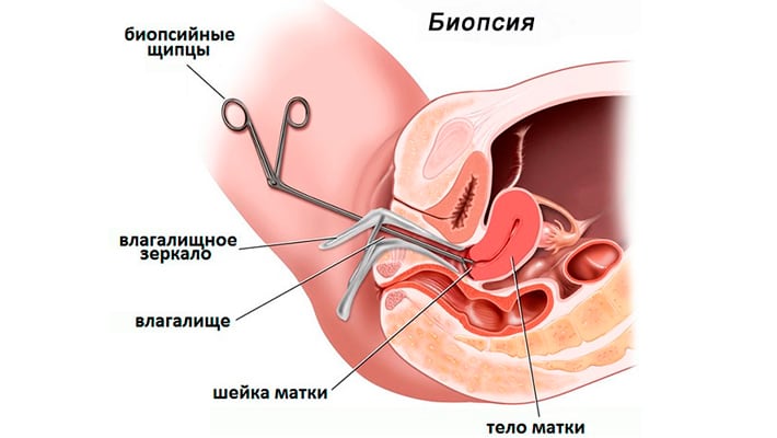 Схема прицельной биопсии шейки матки