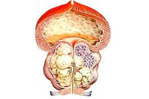 Аденома простаты