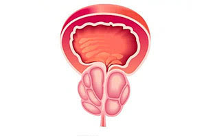Аденома предстательной железы
