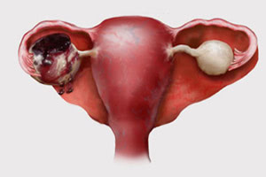 Причины апоплексии яичника