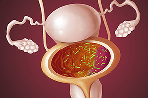 Диагностика цистита у женщин