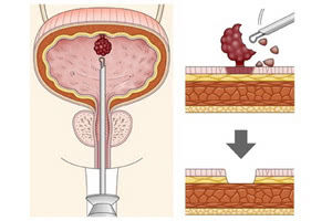 Хирургическое удаление доброкачественных опухолей мочевого пузыря