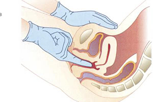 Выполнение гинекологического массажа матки
