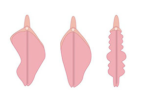 Различные формы малых половых губ