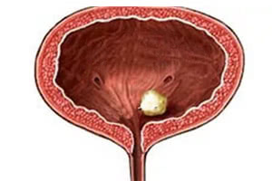 Инородное тело мочевого пузыря