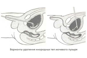 Удаление инородных тел в мочевом органе