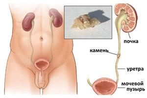 Камни мочеточника