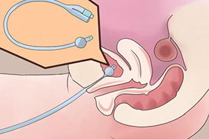 Последствия катетеризации мочевого пузыря у женщин thumbnail