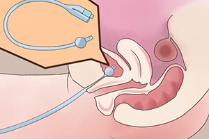 Этапы и особенности катетеризации мочевого пузыря у женщин