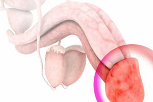 Лечение баланопостита у мужчин