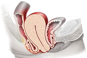 Опущение матки и возможности его лечения