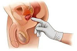 Техника проведения массажа простаты
