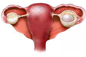 Лечение параовариальной кисты