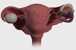 Симптомы перекрута кисты яичника лапароскопия в