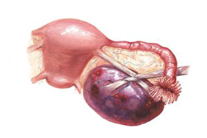 Перекрут ножки опухоли яичника