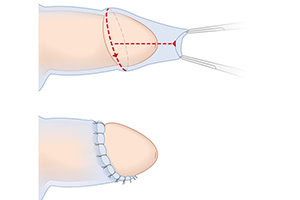 Пластика крайней плоти при фимозе