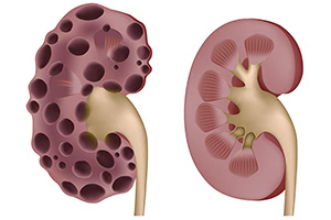 Поликистоз почек: особенности заболевания, диагностика и лечение болезни