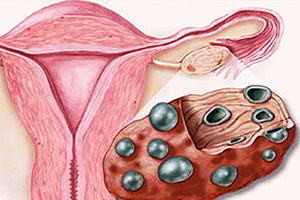  Как выглядит поликистоз яичников