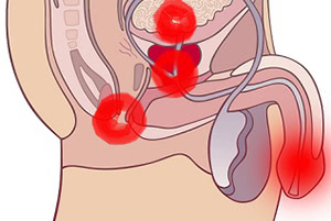 Первые симптомы простатита: как определить болезнь у мужчин