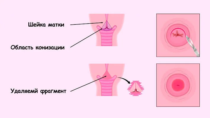 Конизация шейки матки в Москве
