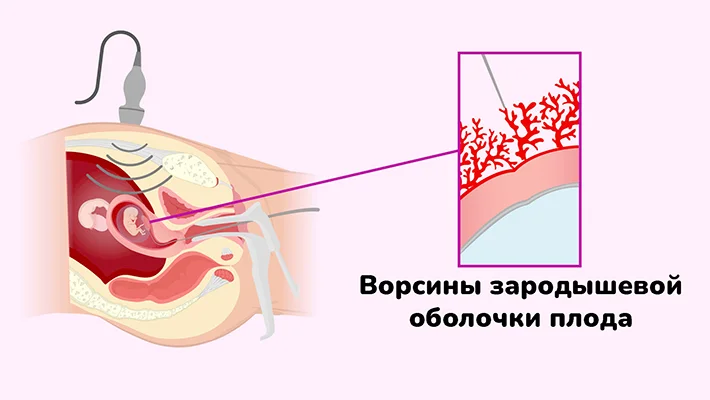 Биопсия хориона в Москве