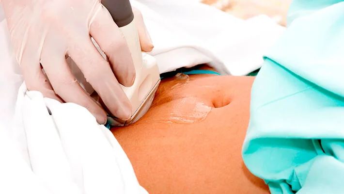 Фолликулометрия