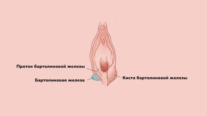 Удаление кисты бартолиновой железы в Москве