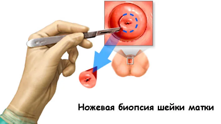 Биопсия шейки матки в Москве