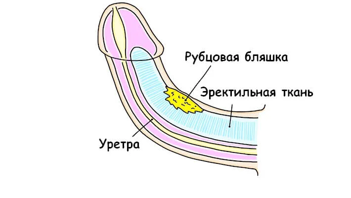 Коррекция искривления полового члена