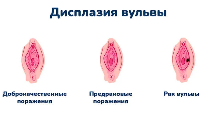 Дисплазия вульвы