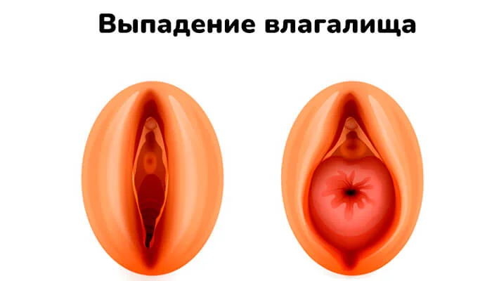 Выпадение влагалища