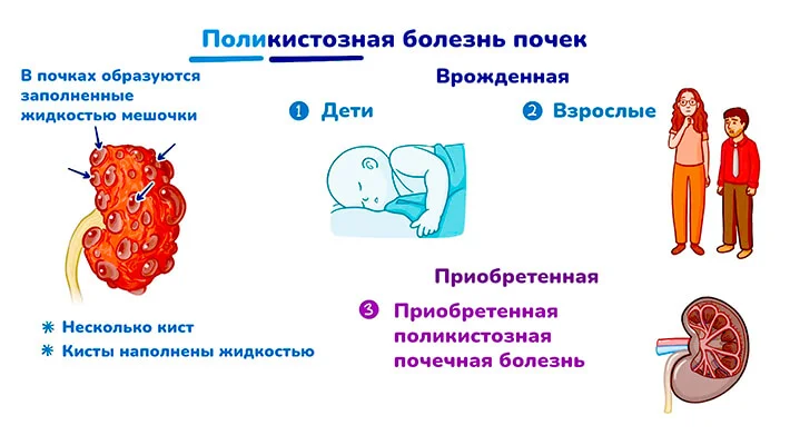 Поликистозная болезнь почек