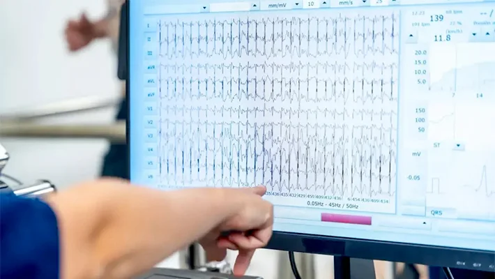 Синусовая аритмия