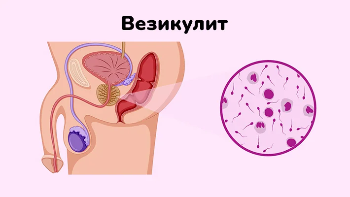 Везикулит