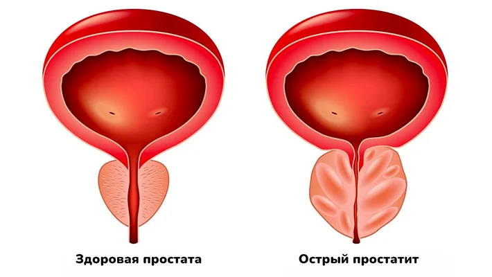 Острый простатит