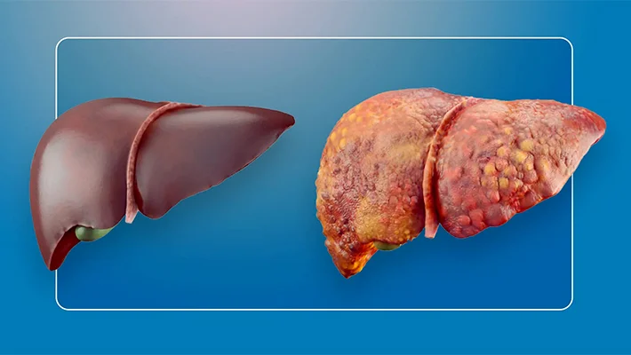 Цирроз печени