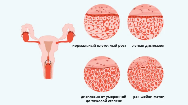 Лазерное лечение дисплазии шейки матки