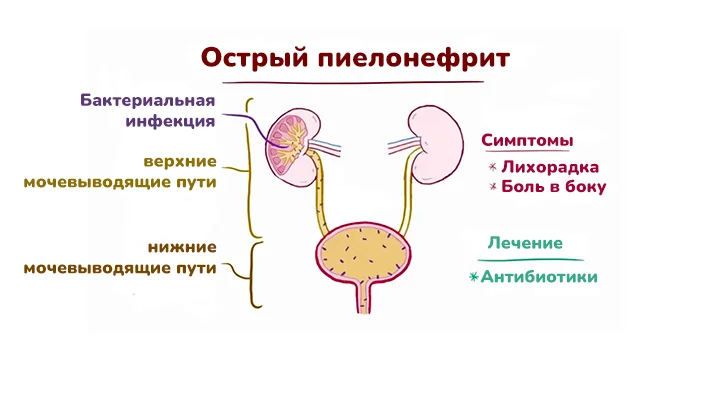 Причины острого пиелонефрита