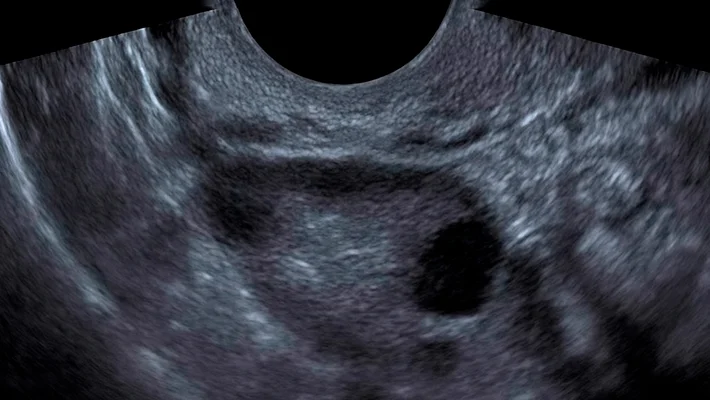 УЗИ яичников у женщин