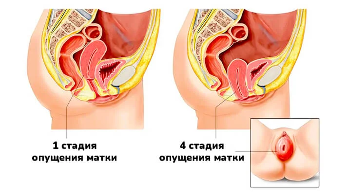Стадии опущения матки