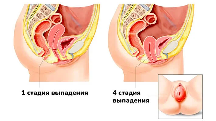 Стадии выпадения влагалища