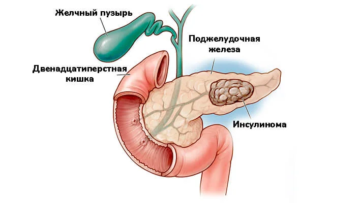 Инсулинома поджелудочной железы