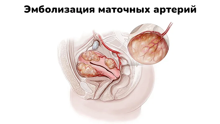 Эмболизация маточных артерий