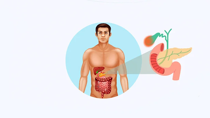 Холецистит
