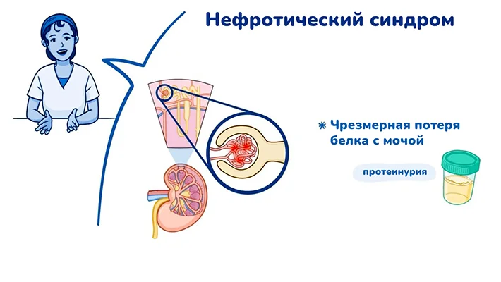Потеря белка при нефротическом синдроме
