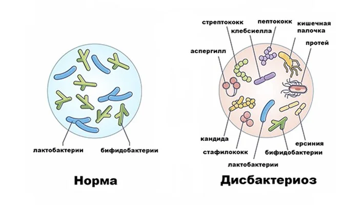 Причины дизбактериоза