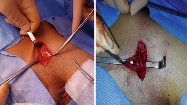 Как делают операцию Мармара