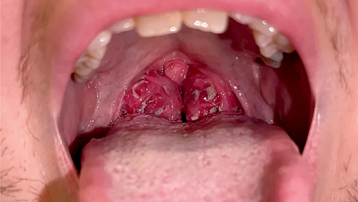 Инфекционный мононуклеоз